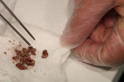 Estetik ameliyatta şaşırtan olay