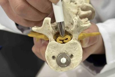 Beldeki gizli tehlike: Spinal stenoz