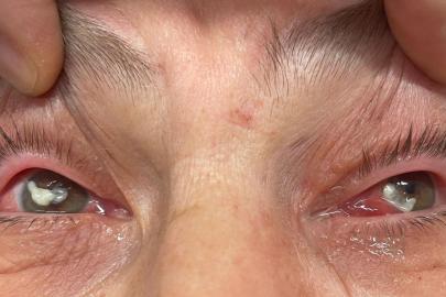 ’Kırlangıç otu kullanımı’na dikkat, uzmanlar uyarıyor: "Gözlerine suyunu damlattı, göremez hale geldi"