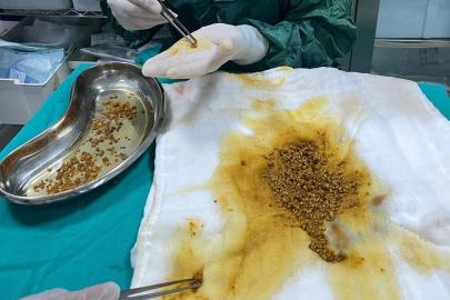 Nadir vaka: Safra kesesinden 2 bin 67 taş çıkarıldı