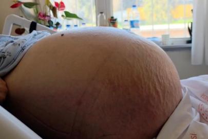 Karnındaki devasa şişlik 22 kiloluk tümör çıktı: "Kabızlık diye düşündüm" dedi